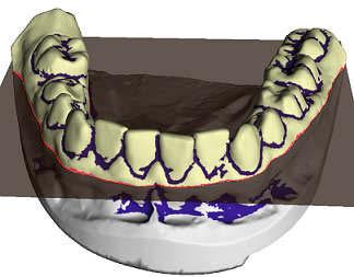 232 5 CONCLUSION We have presented a hghly automated segmentaton method for separaton of teeth from trangular meshes.