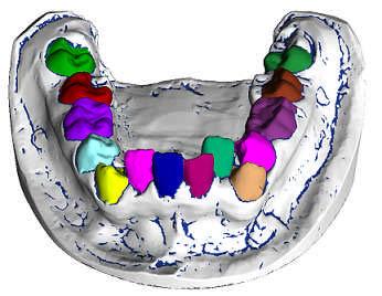 (a) (b) (c) (d) (e) (f) Fg. 10: The dental model s cut by the best fttng plane (a).