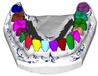 Free State of Saxony. We lke to thank Image Instruments for provdng the dental models. REFERENCES [1] Cadent, http://www.orthocad.