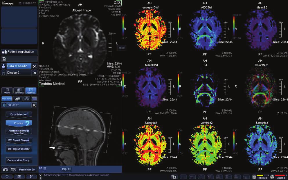 Diffusion Tensor Imaging and Tractography Diffusion tensor imaging enables the detection of diffusion and anistrophy which can provide a clear image of