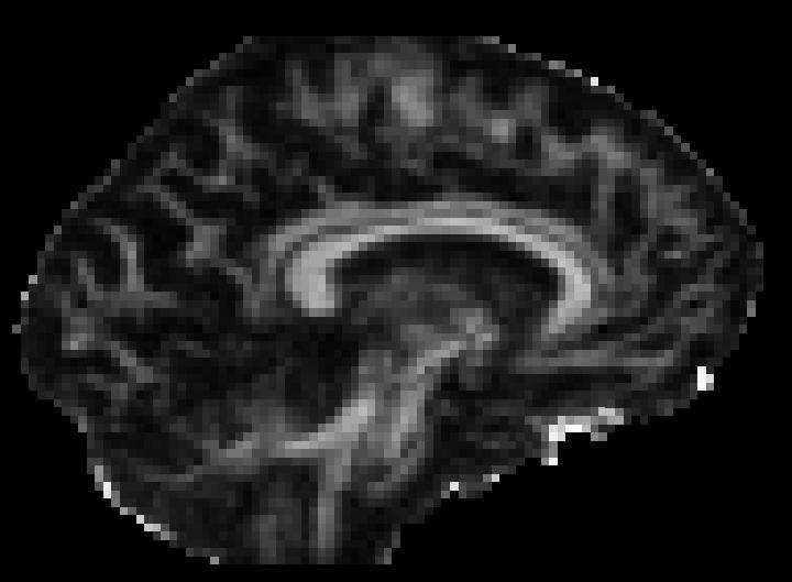 Imaging the white matter using diffusion tensor imaging Fractional anisotropy (FA) Higher FA