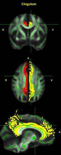 Neuroanatomical atlases may define ROIs Less time
