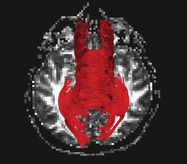 6 Computational Intelligence and Neuroscience Top view Right view S R (a) (b) Figure 5: Top and right view of corpus callosum tractography for a 50-year-old healthy male subject.