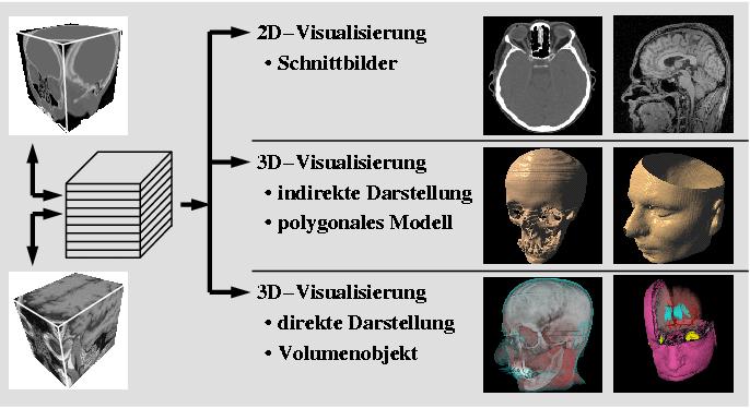 Volume Visualization 2D visualization: slice images (or multi-planar reformation: MPR) Indirect 3D
