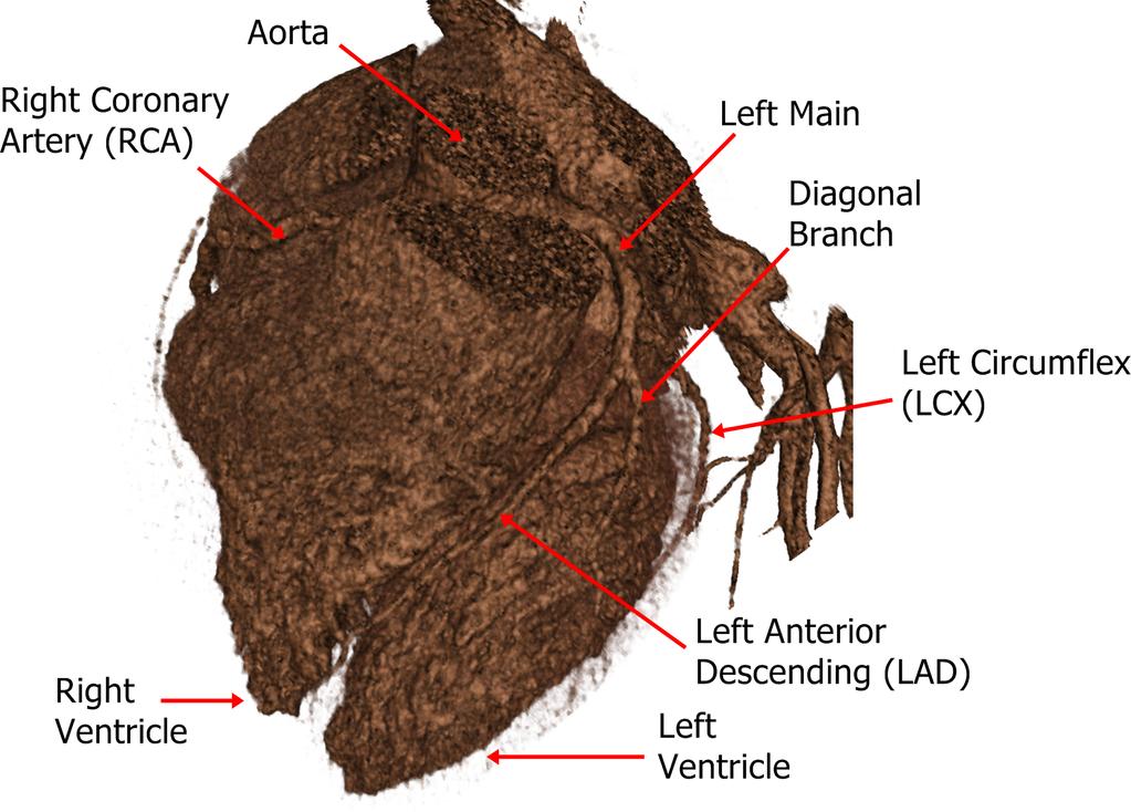 48 Figure 4.1 CT volume visualized by using ray casting method showing the heart and different coronary arteries.