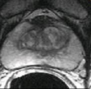 , Zhang 04]; Prostate tissue