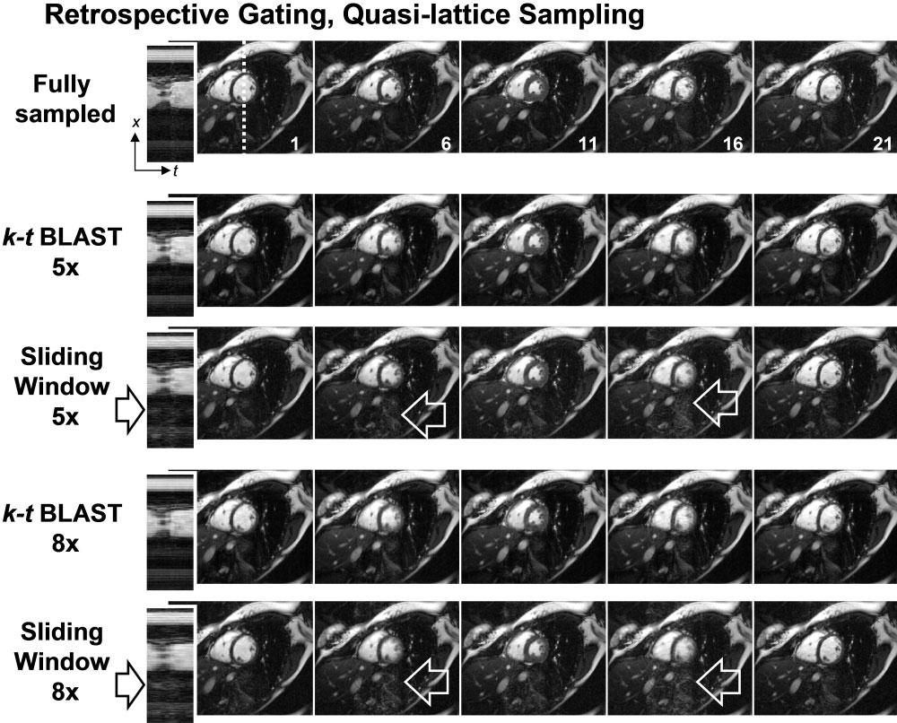 90 Hansen et al. FIG. 5. Reconstruction errors for retrospectively gated Cartesian imaging.