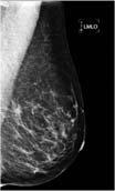 High Risk Patients 2 cancers found only with Tomosynthesis 6 more visible with Tomosynthesis 5 of these 8