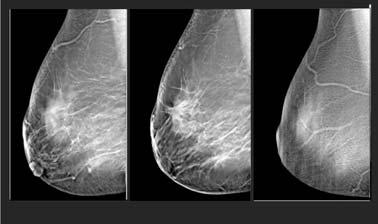Reconstructed Images Reconstructed Images Thinner breast Thicker breast