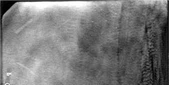 Better Sensitivity Slice at plane of phantom insert Tomosynthesis shows improved low contrast visibility over digital mammography Tomo Clinical