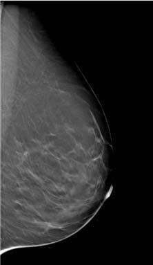 breast Reduced dose Fewer Recalls Removal of confusing overlying