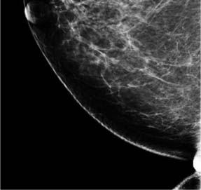 artifact Sickles July 2012 SBI forum post 2D Mammogram Tomosynthesis