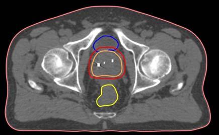 Prostate case: Online dose accumulation 25 CTV-to-PTV margins: - 1, 3 & 5 mm isotropic - 3 mm