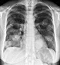 A Structured Report to Encode as a DICOM SR Chest X-ray Report: Recording Observer: Clunie^David^A^Dr.