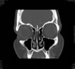 Figure 5 shows an example of sinus CT- images of a patient in different angular positions.