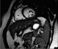9 mm D Experimental Results Case - Short axis MR cardiac