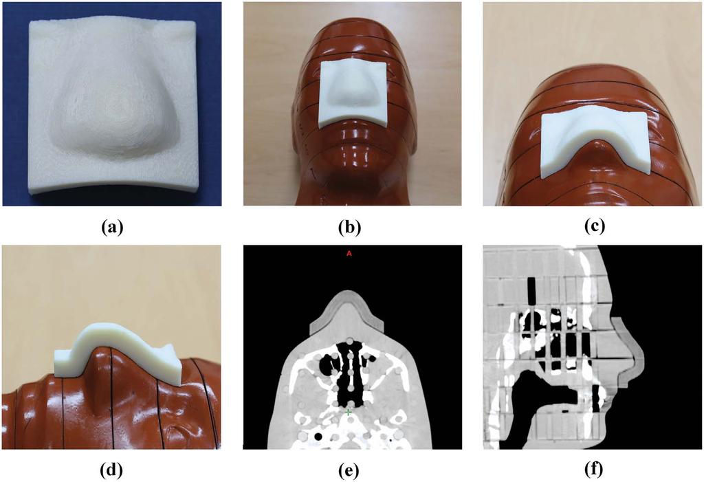 Figure 4. The 3-dimensional (3D) printed customized bolus.