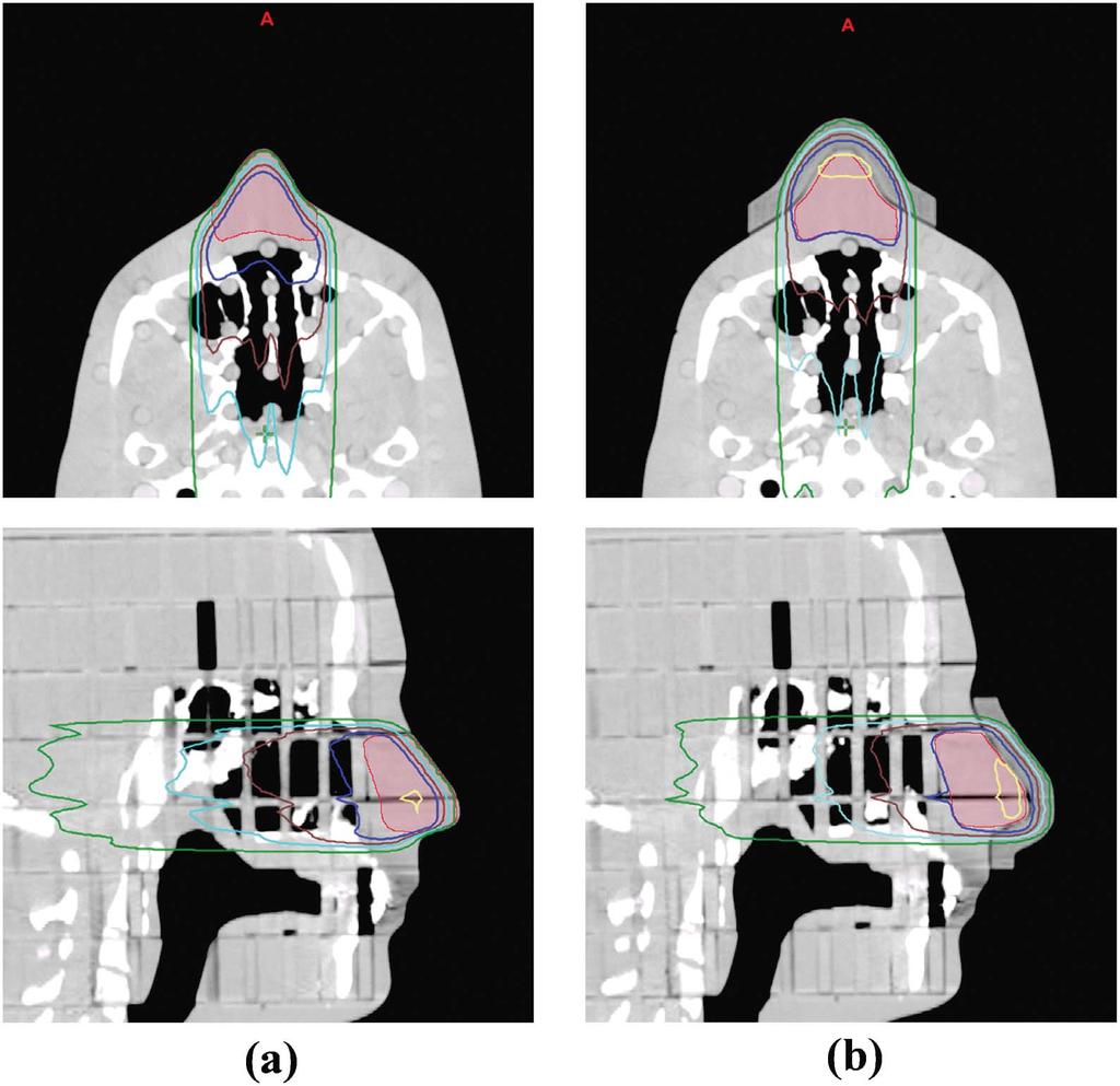 Figure 5. Dose distributions of the two treatment plans from the RANDO phantom study. (a) Plan without a bolus, (b) plan with the 3D printed customized bolus.