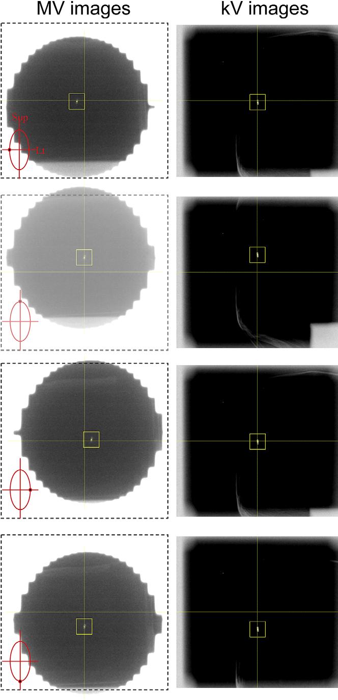 Combined kv/mv image-guided real-time DMLC target tracking d B. CHO et al. 861 Fig. 3. Example of an MV image obtained during the same experiment as Fig. 2.