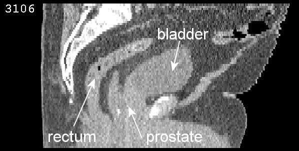 Note how the changes in size and shape of the bladder and rectum are accounted for.