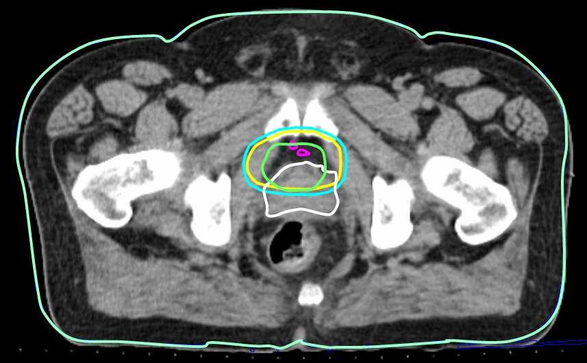 Large deformation 3D image registration in image-guided radiation therapy 22 for the prostate from both the planning day and treatment day 2 are shown, along with isodose lines for 95%, 98%, and 100%