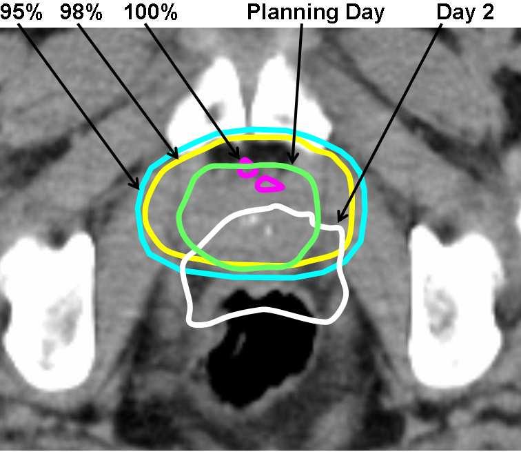 Left: The treatment image from day 2, shown with a skin contour from the planning day. Top right: Planning image. Bottom right: Day 2 image.