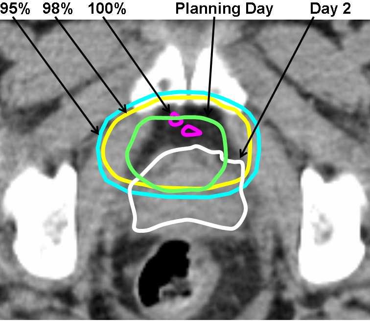 The top panel shows a full axial slice of the treatment image from Day 2, with an overlaid skin contour from the planning image as an indication of setup accuracy.