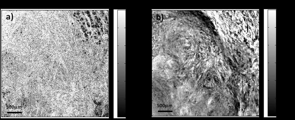 CHAPTER 5 RESULTS Figure 5.7 - En face planes a) of a 3D-OCT dataset and b) 3D-OCE dataset (depth, 30 m) of a sample of breast tissue removed in a mastectomy procedure In the OCT image (Figure 5.