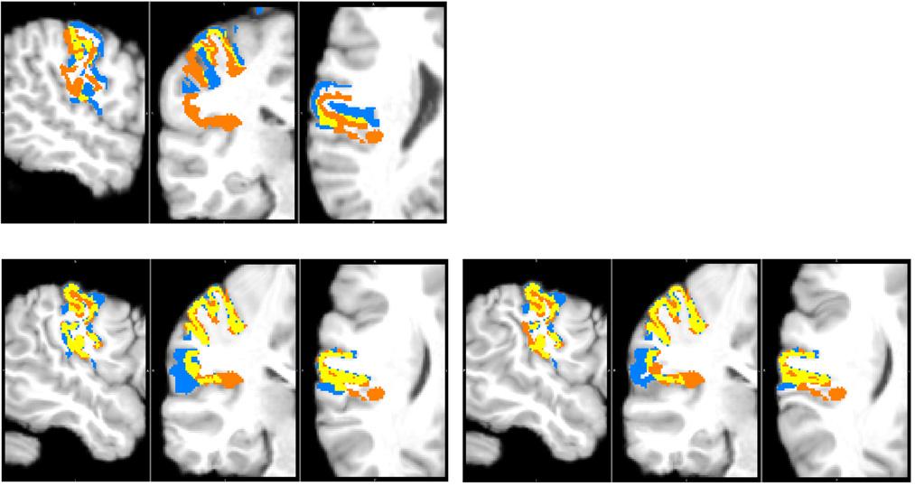 I.J.A. Simpson et al. / NeuroImage 59 (01) 438 451 447 Fig. 8. An example registration result, highlighting some issues with using an inappropriate level of regularisation.
