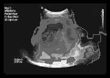 (c) (d) (e) Figure 6 (a-f). Final segmented results for liver cyst image after Fig. 4 (a-f) with = 10 and B = 0.