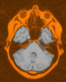 BET: brain extraction = skull stripping 1. segmentation goal: automatic segmentation of brain & non-brain tissue (skin, skull, eyeballs, etc.
