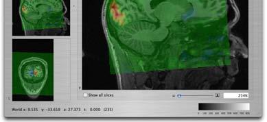 In NeuroLens it is also possible to overlay an activation map on a highresolution anatomic scan even though the image dimensions and slice angulations are in