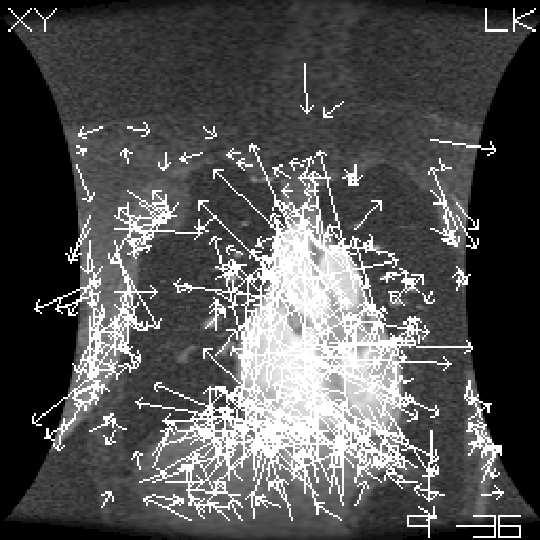 3D L&K OF for Gated MRI Cardiac Data LK-XY-9-36 (5phase) LK-XZ-9-36 (5phase) LK-XY-16-36 (10phase) LK-XZ-16-36 (10phase) Figure 8: The Lucas and Kanade XY