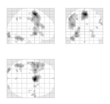 SPMmip [-30, 3, -9] 3 Visualising results remembered vs. fixation contrast(s) < < After the results table - what next?