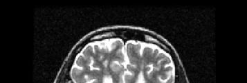Brain MRI segmentation pipeline : Five main steps A rigid registration of the T1 on