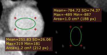 32 2.6.2 RadiAnt DICOM Viewer Ellipse Select "Ellipse" from the "Measurements" drop down menu (or press the E key).