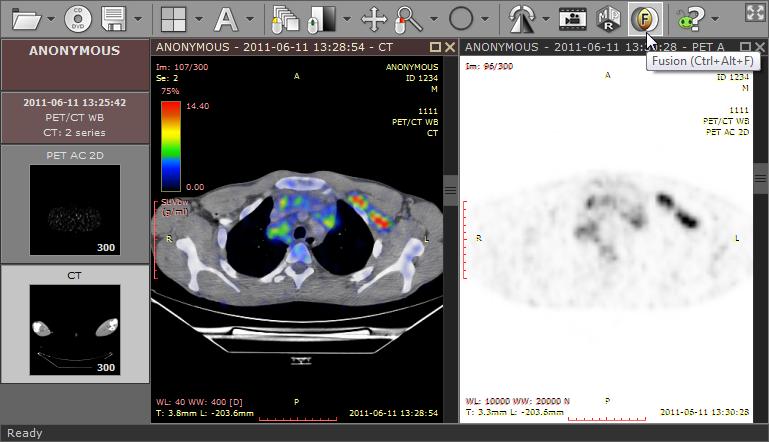 64 RadiAnt DICOM Viewer 3) Click the "Fusion" button on the
