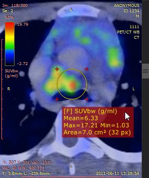 66 RadiAnt DICOM Viewer SUV measurement Use the ellipse tool in the panel with fused images to measure maximum, minimum and average values of SUVbw (Standardized Uptake Value calculated using body