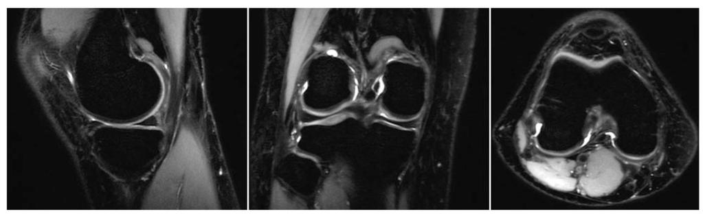 Busse et al. Page 20 FIG. 8. PD-weighted whole-knee imaging. Radial modulation view ordering produces PD-weighted contrast. A 256 256 200 (0.