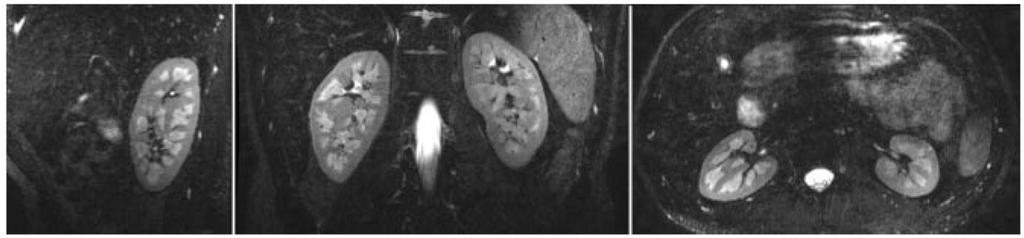 Busse et al. Page 21 FIG. 9. Volumetric kidney imaging. A T 2 -weighted image volume with a 320 320 128 matrix (1.