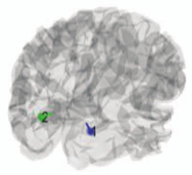 (a) The upper part shows the dipole location through the transparent cortical mesh; the middle part shows the correspondence between observed and predicted scalp data in two ways (topographies and
