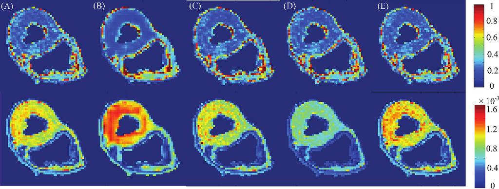 S598 Fig. 4. Maps of FA first row) and MD second row) of the real human heart data with 25% sampling rates. A) Reconstruction from the complete k-space data.