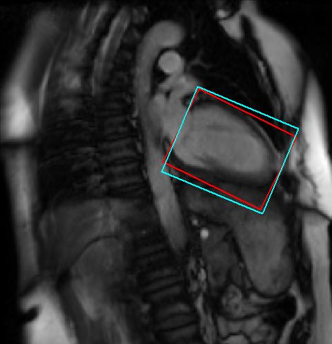 Fig. 5. Left ventricle detection results on 2D MRI images. Red boxes show the ground truth, while cyan boxes show the detection results. Table 2.