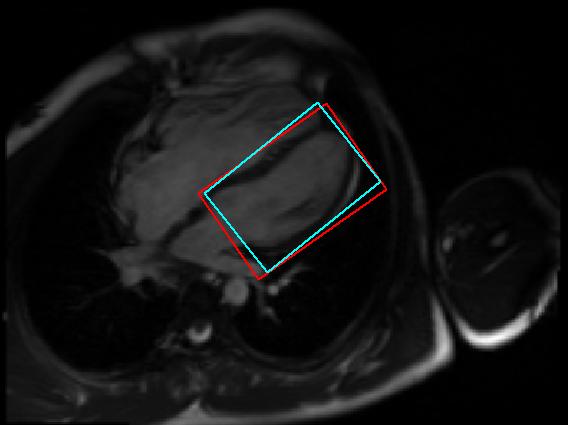 1 Left Ventricle Detection in 2D MRI Images In this experiment, we quantitatively evaluate the performance of marginal space learning (MSL) and