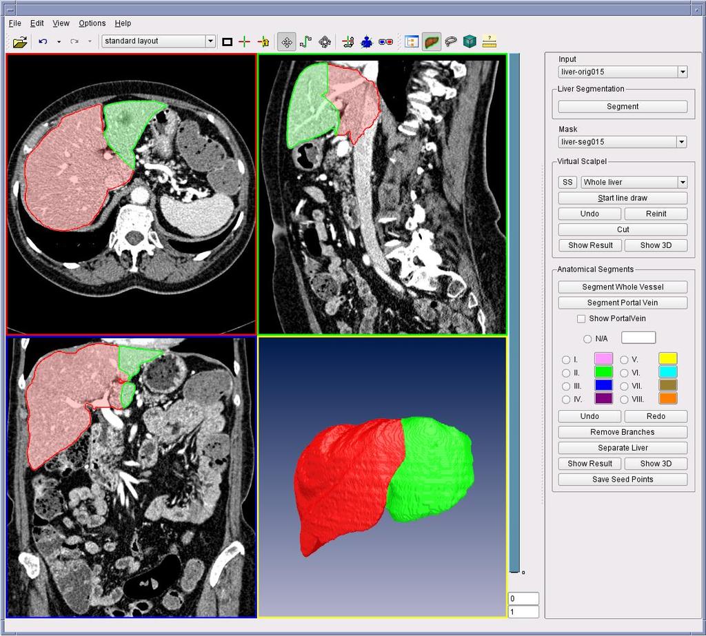 4.2 Evaluation of virtual volume resection 4.2.1 Test data and methodology One clinical application of virtual volume resection is liver segment separation [101].