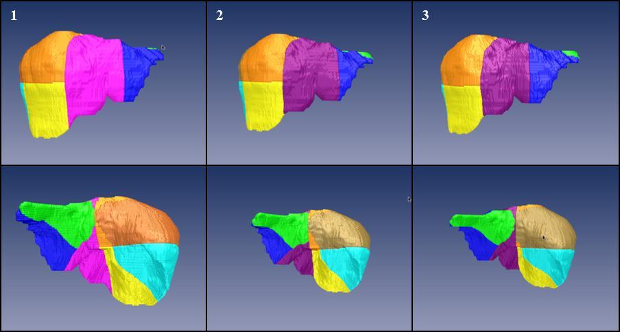 4.2 Evaluation of virtual volume resection respectively.