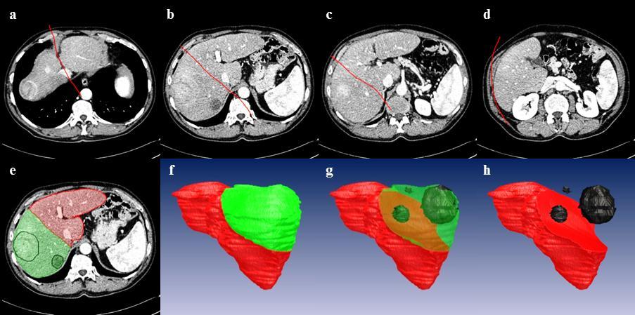 4.2 Evaluation of virtual volume resection Figure 4.10 Virtual tumour resection, case study 1: definition of cutting surface on axial slices (a-d), and the result in axial (e) and 3D (f, g, h) views.