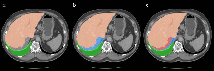 2.1 Single-phase method for CT images to the target region, so it does not cause over-segmentation in other parts of the liver. The result of the additional segmentation (Fig. 2.