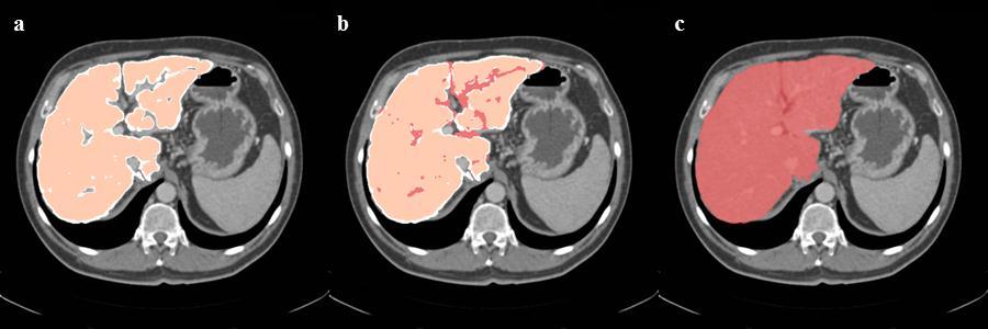 7 Additional segmentation at the right lung: The liver can be under-segmented due to lower intensities near the lung (a), region of interest between the liver and lung surface is localized (blue b),