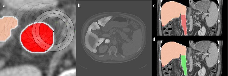 2.1 Single-phase method for CT images segmented image, and all of them is added to the liver except for the largest one which represent the real background.